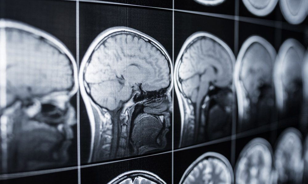 New Jersey Traumatic Brain Injury Lawyer